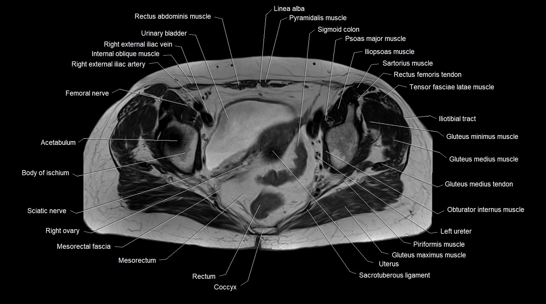 MRI 3T pelvis axial cross section anatomy image 19.webp